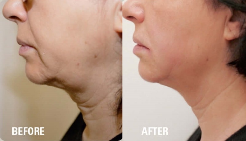 Ultraformer HIFU Before & after photo